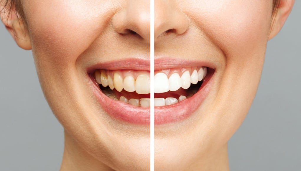 أسنان المرأة قبل وبعد التبييض