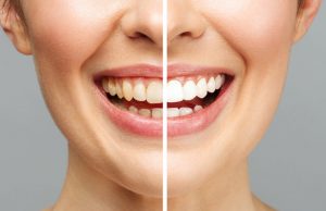 أسنان المرأة قبل وبعد التبييض