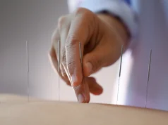 الإبر الصينية للإقلاع عن التدخين